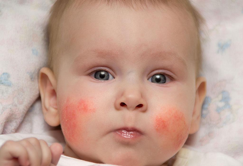 Как аллергия на щечках у ребенка thumbnail