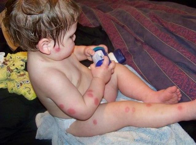 Аллергия у ребенка на укусы насекомых