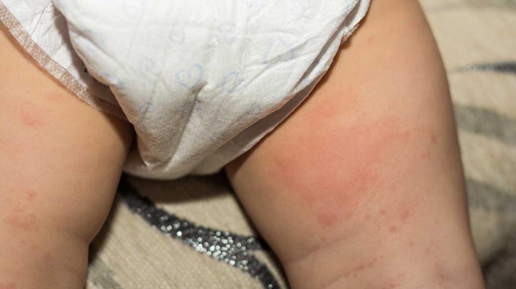 Аллергическая сыпь на попе у новорожденного thumbnail