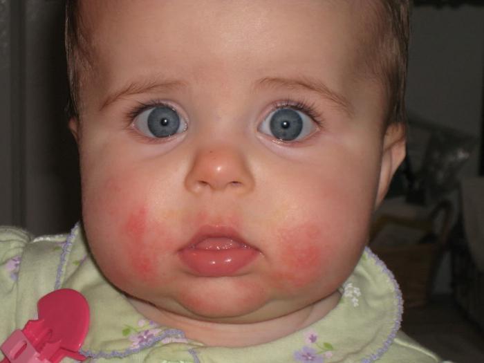 Как выглядит аллергия у грудничка на лице фото