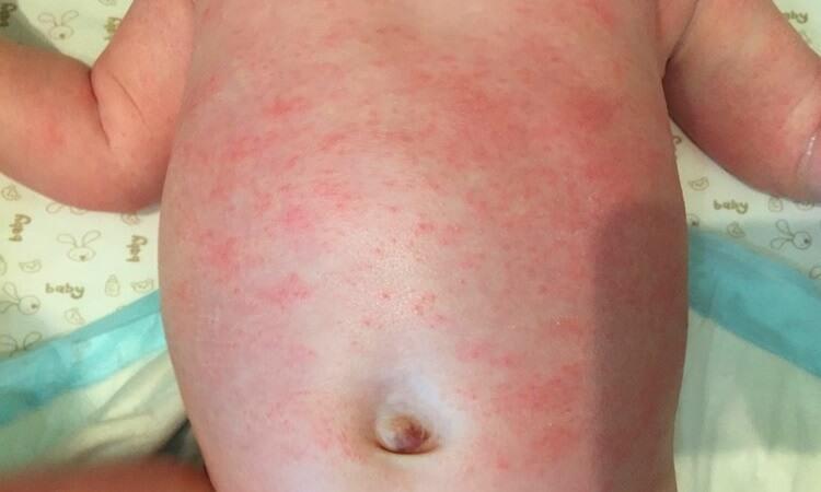 Можно ли выявить у грудничка на что аллергия thumbnail