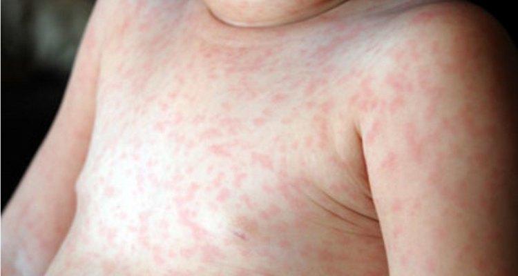 Сыпь на теле у ребенка без температуры без зуда с фото thumbnail