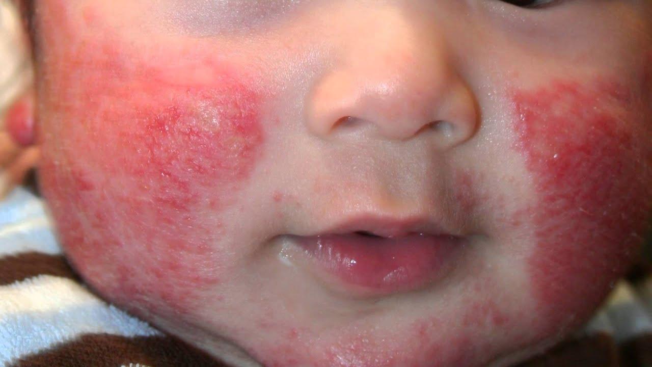 Белая сыпь на теле у ребенка 4 года thumbnail