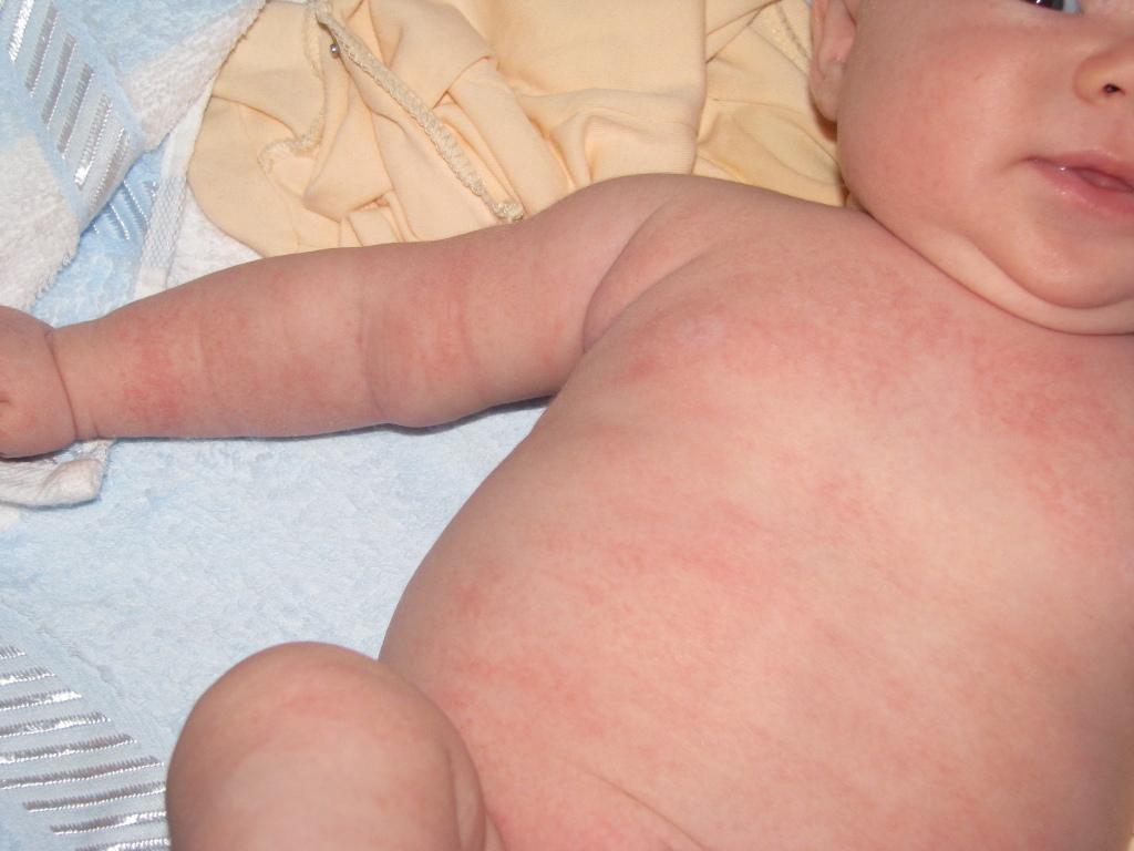 Красная сыпь по всему телу у ребенка без температуры thumbnail