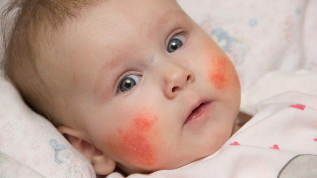 Капли от аллергии новорожденному какие можно thumbnail