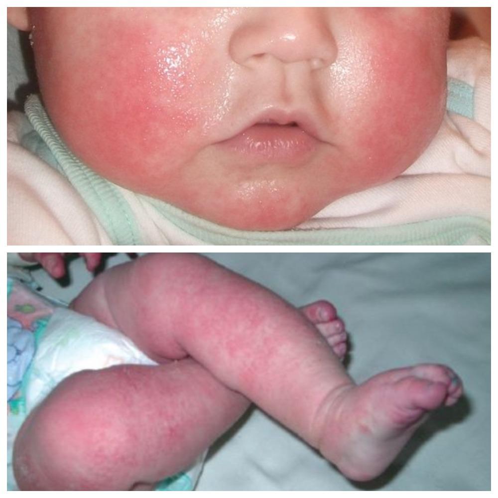 Цветение кожи лица у новорожденного thumbnail