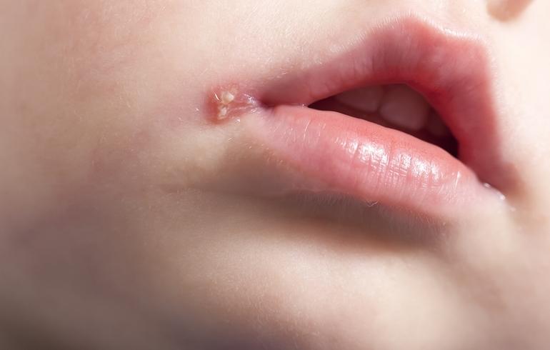 Сыпь вокруг рта у ребенка лечение народными средствами thumbnail