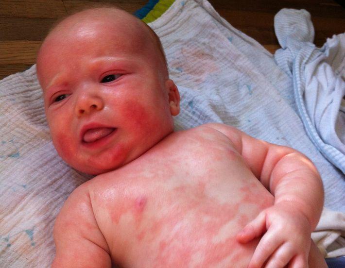 Аллергия у младенца