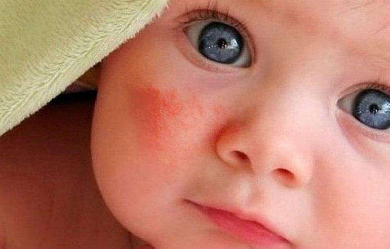 Чем можно кормить ребенка при аллергии на лактозу thumbnail