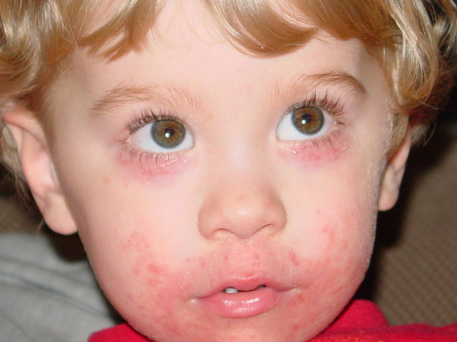 Аллергия на гречневую кашу у ребенка 5 месяцев thumbnail