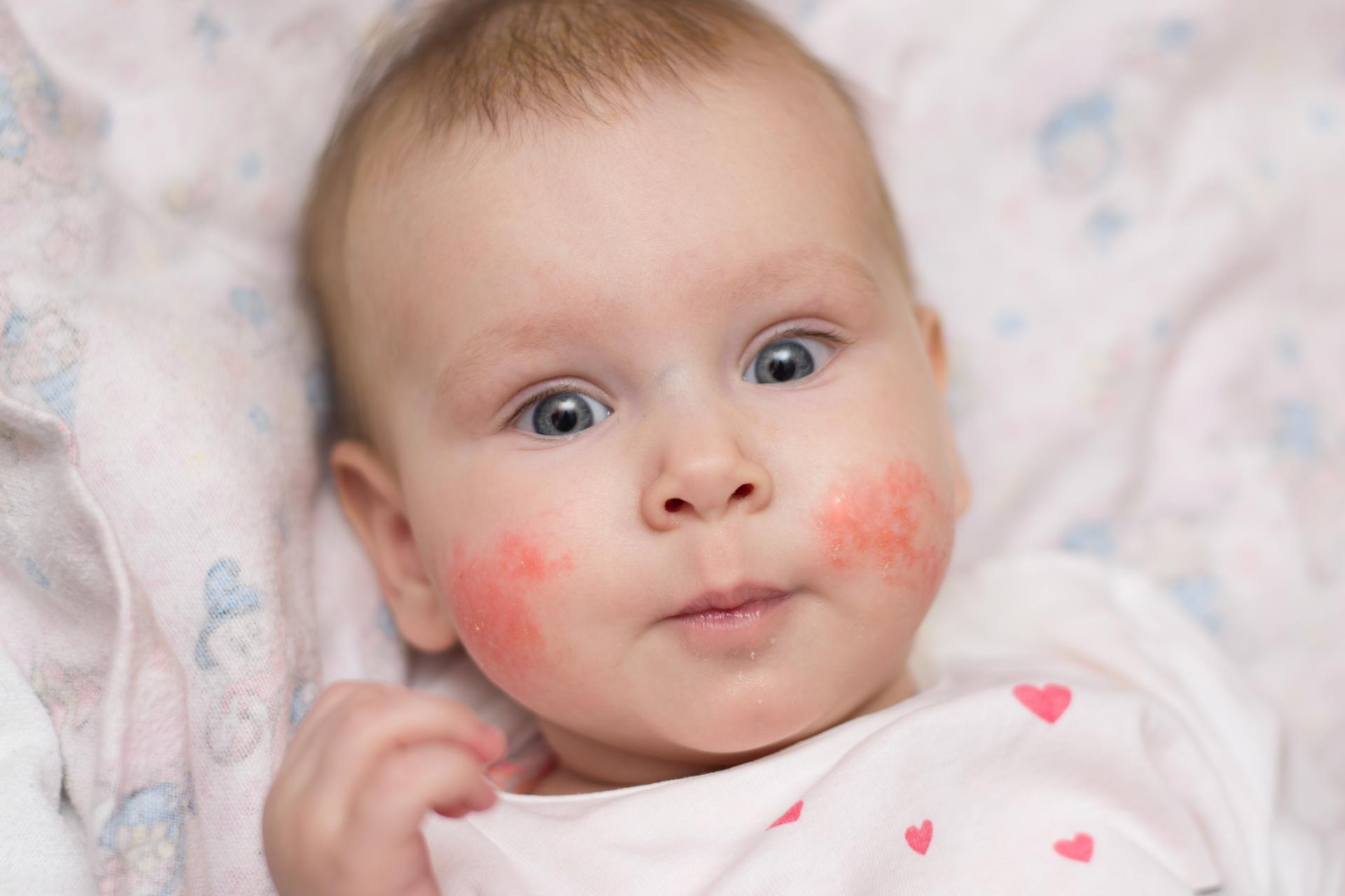 Пищевая аллергия у младенца