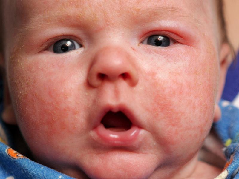Смесь для новорожденных против аллергии thumbnail