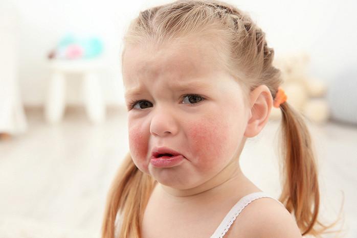 Аллергия на киви у детей