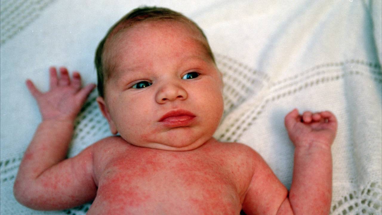 У детей до года как отличить аллергию от потницы thumbnail