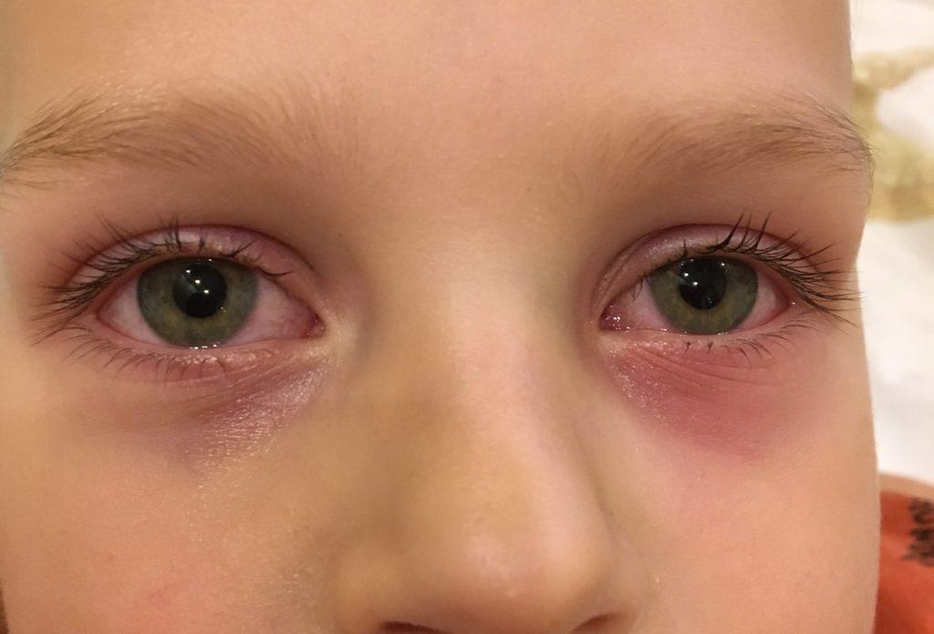 Синяки вокруг глаз у ребенка аллергия thumbnail