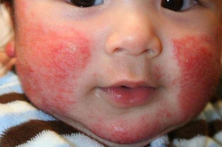Чем отличить аллергию у ребенка от потнички thumbnail