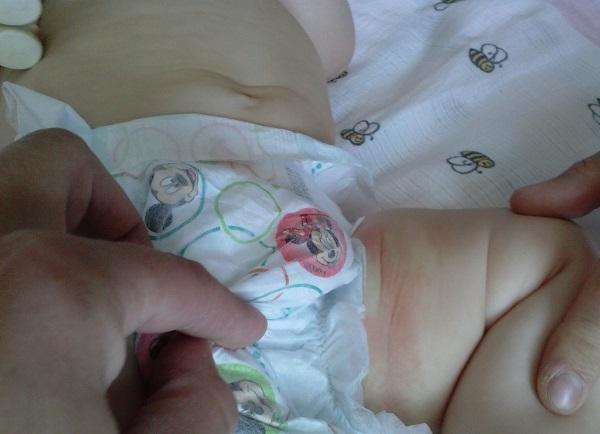 У грудного ребенка понос с кровью фото thumbnail
