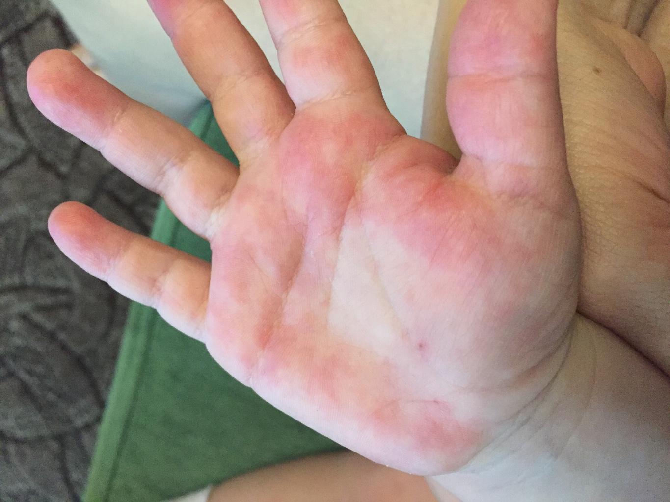 От чего облазит кожа на пальцах рук у ребенка после аллергии thumbnail