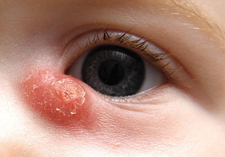 Ребенку 2 месяца красное вокруг глаза thumbnail