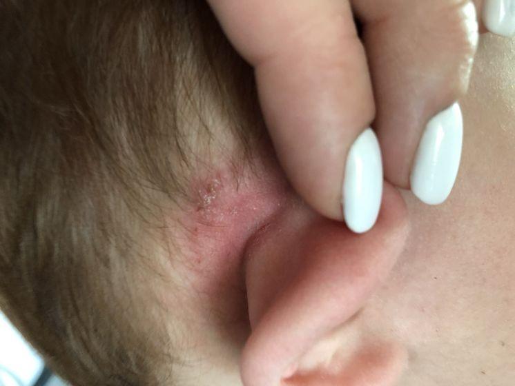 Аллергия за ухом у грудничка thumbnail