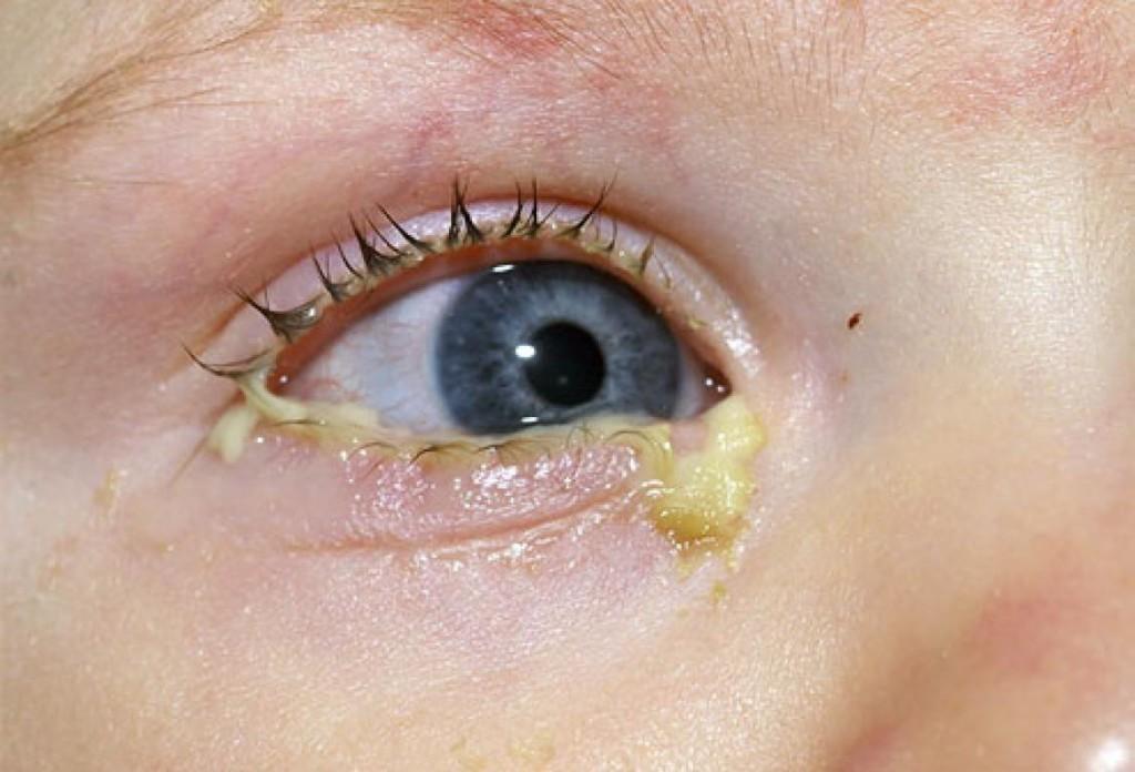 После родов у ребенка красные глаза вокруг зрачка thumbnail