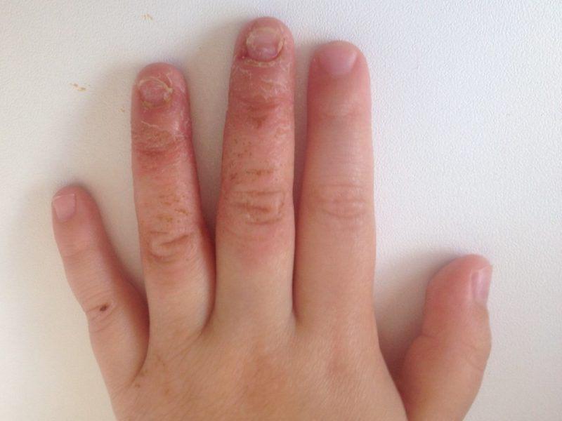 Слезает кожа с пальцев рук у ребенка комаровский thumbnail