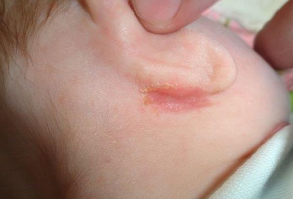Шелушится кожа за ушами у ребенка 1 год thumbnail