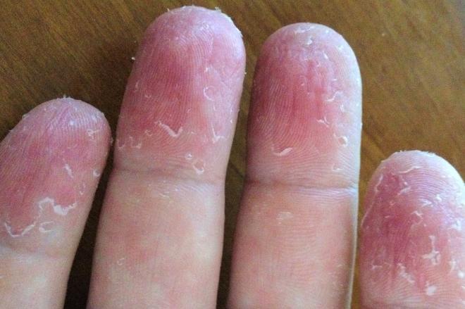 Ребенка слезает кожа на подушечка пальцев рук thumbnail