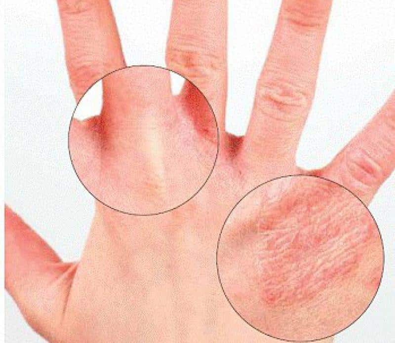 У ребенка слезает кожа с пальцев что делать thumbnail