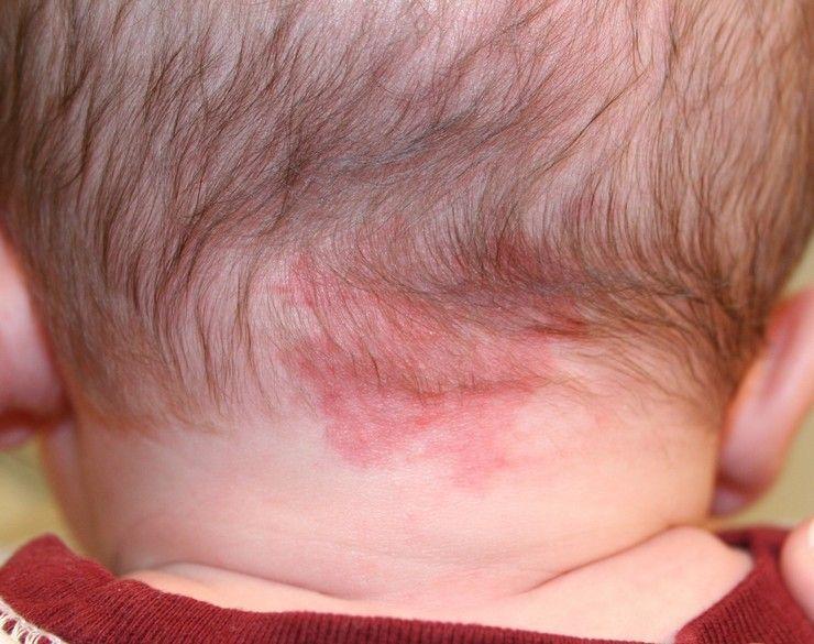 Ребенок 1 год на затылке красное пятно thumbnail
