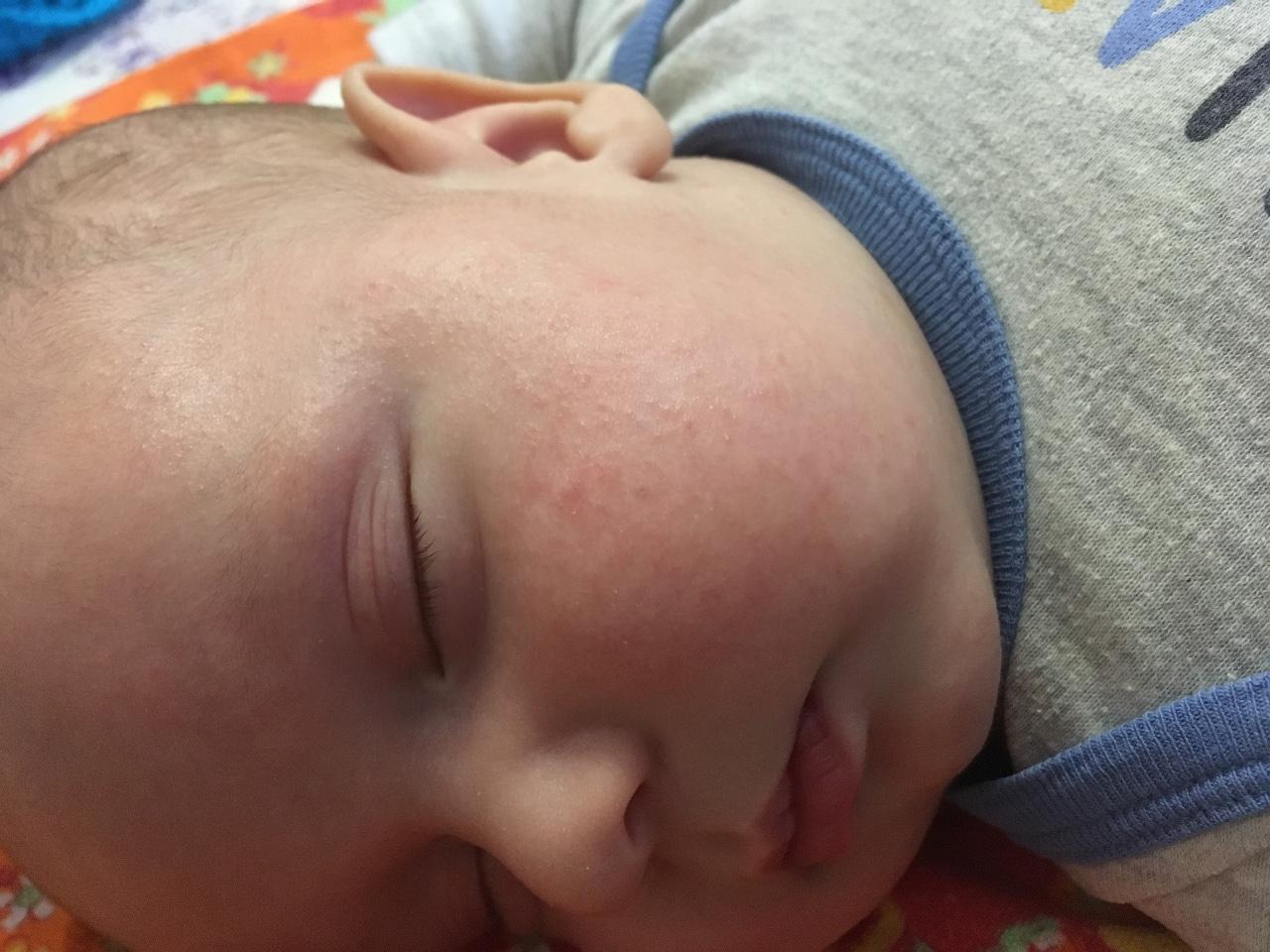 Сыпь на шее и ушах у новорожденных thumbnail