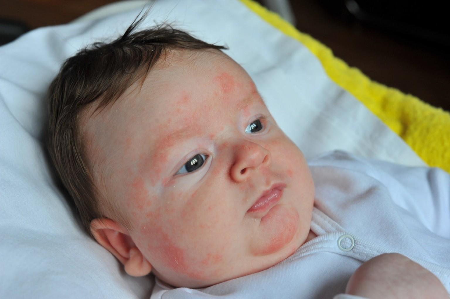 Как может проявиться аллергия у ребенка на сладкое thumbnail