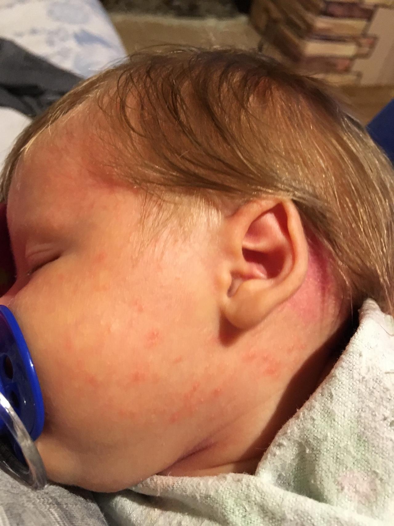Сыпь у новорожденного на шее и теле thumbnail