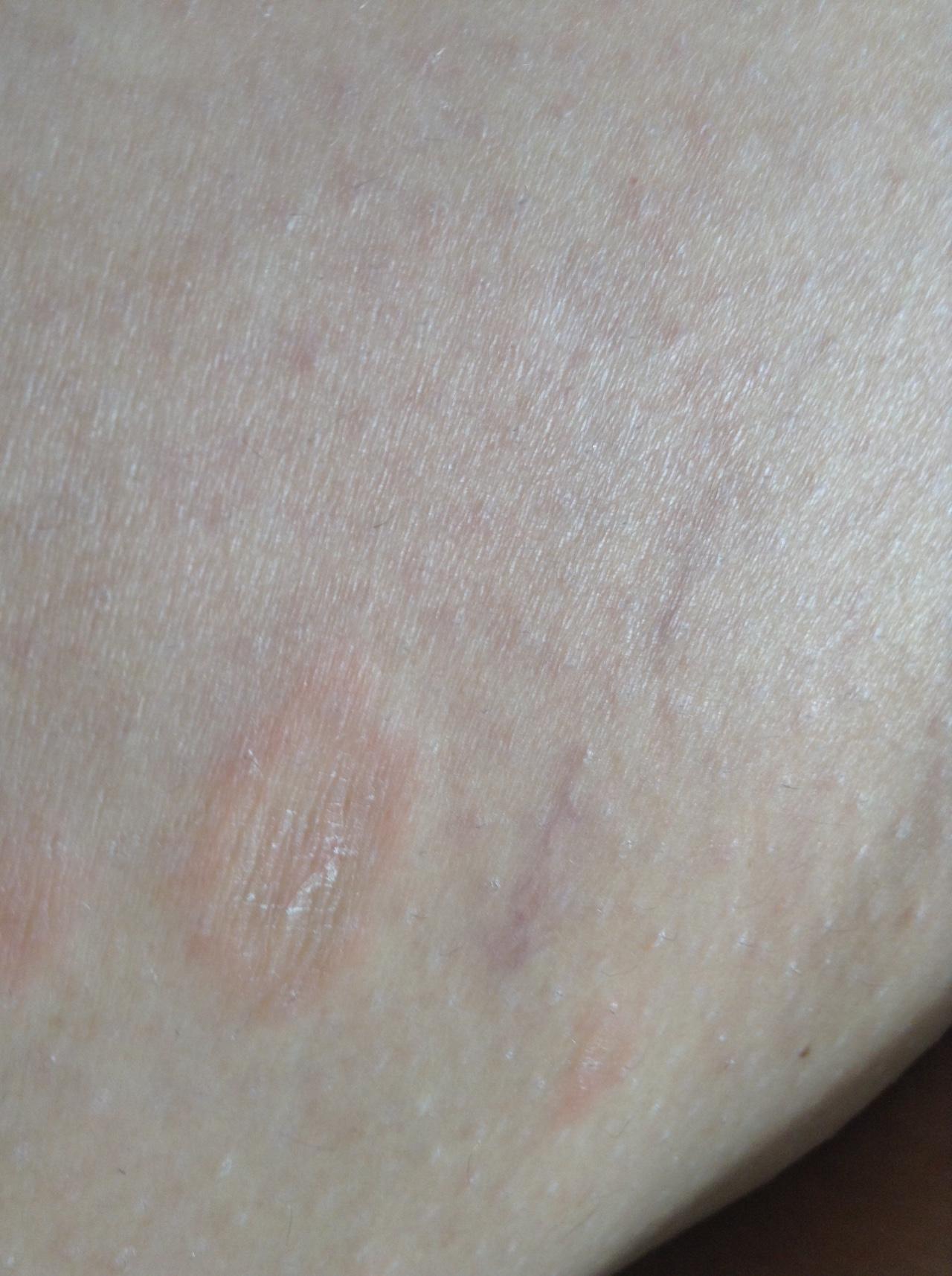 Аллергия на коже ребенка шершавость thumbnail