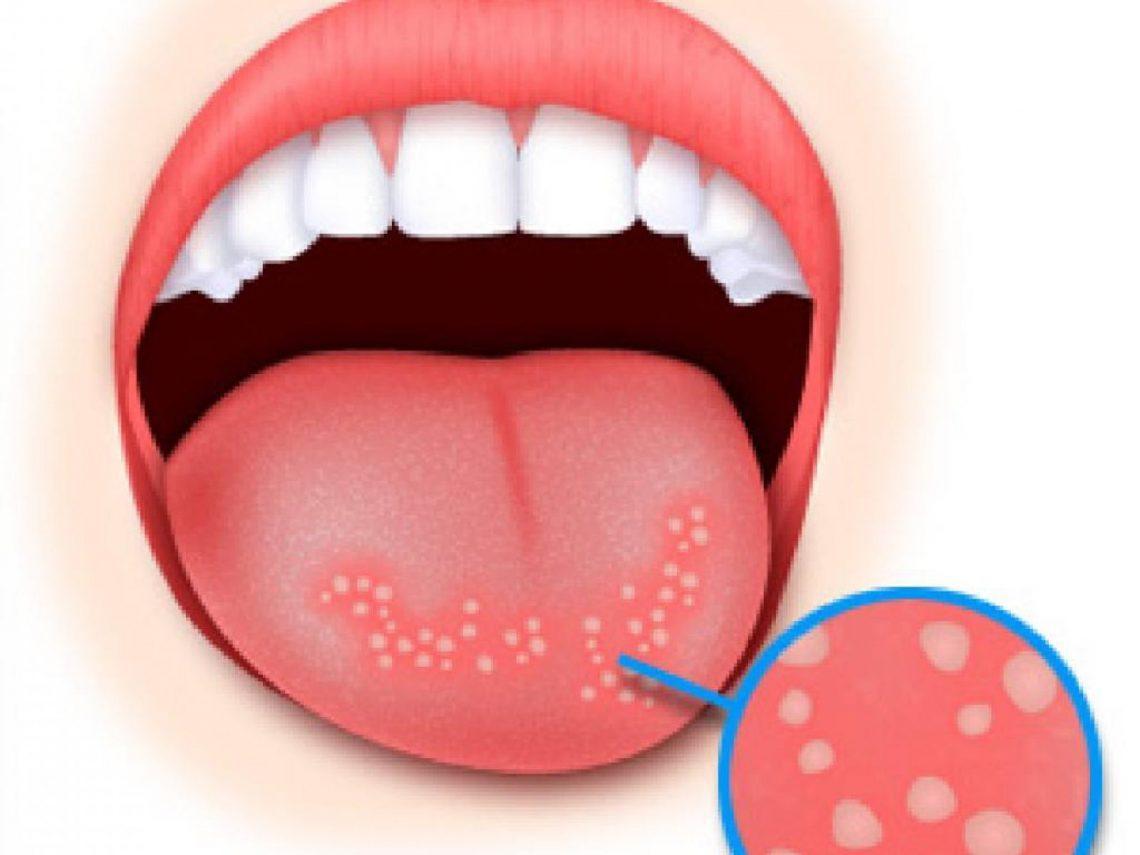 Красные точки во рту у ребенка температура thumbnail