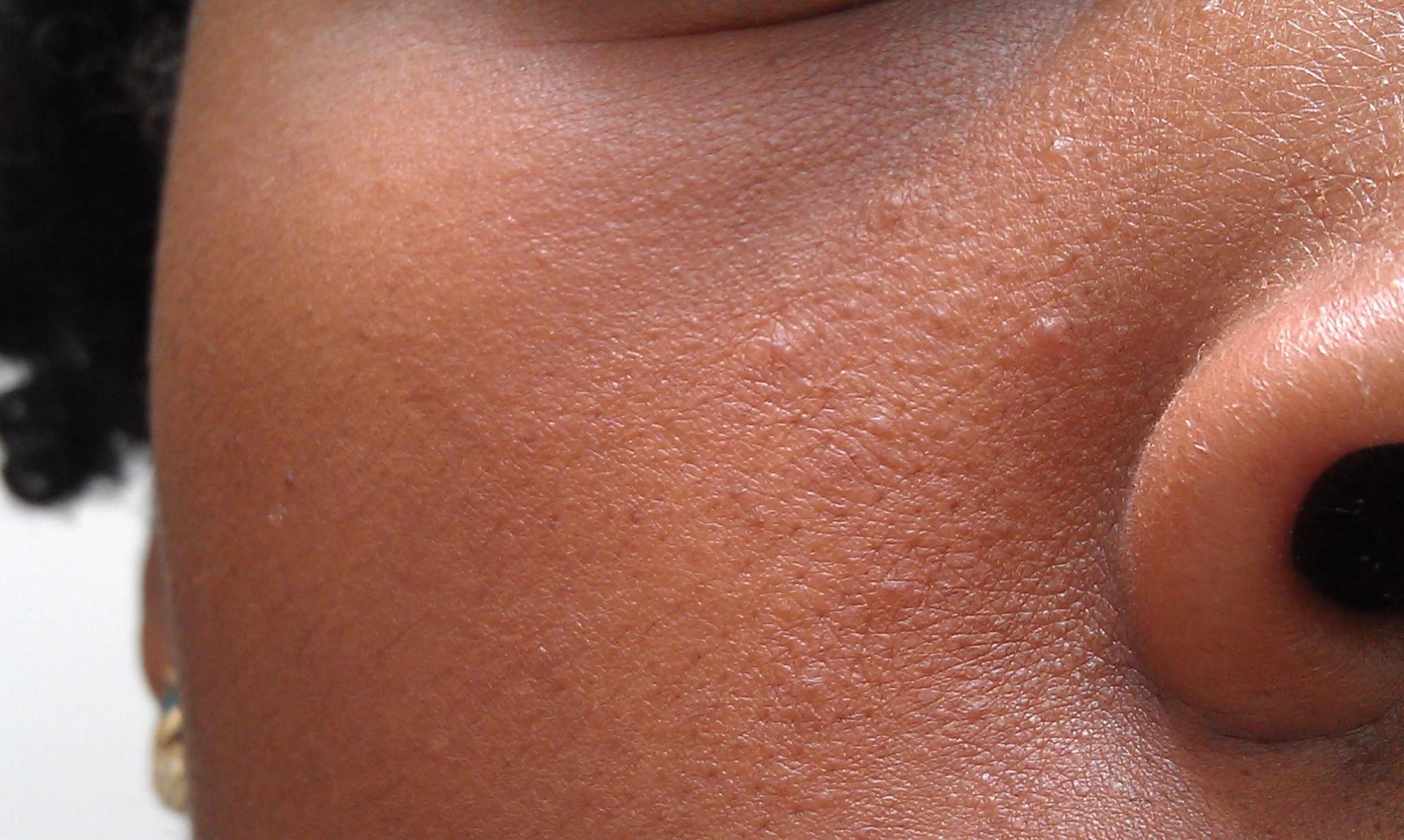 Сухие пупырышки на коже у ребенка фото thumbnail
