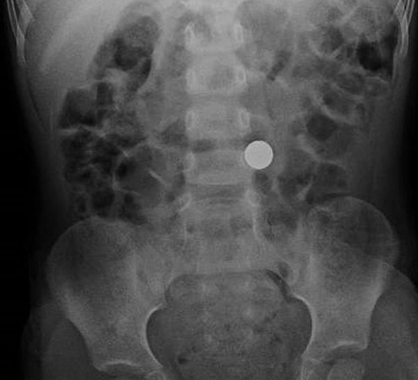 Пример рентгена инородного тела