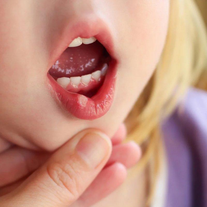Мелкая сыпь во рту ребенка thumbnail