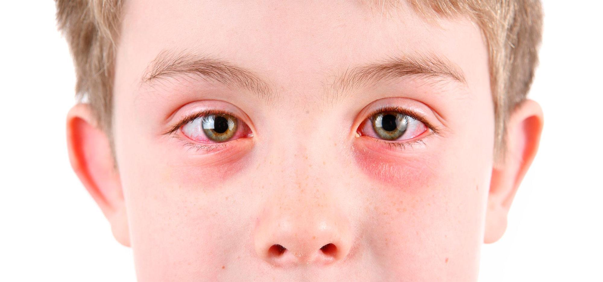 Покраснение глаз, вызванное аллергией