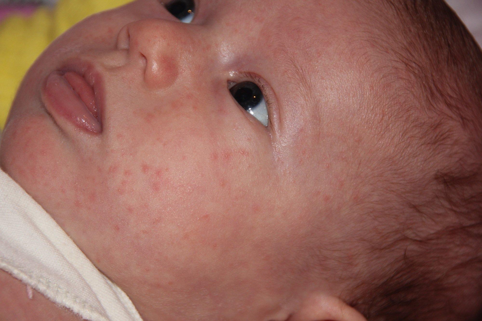 У ребенка 3 месяца шершавые сухие пятна на коже thumbnail