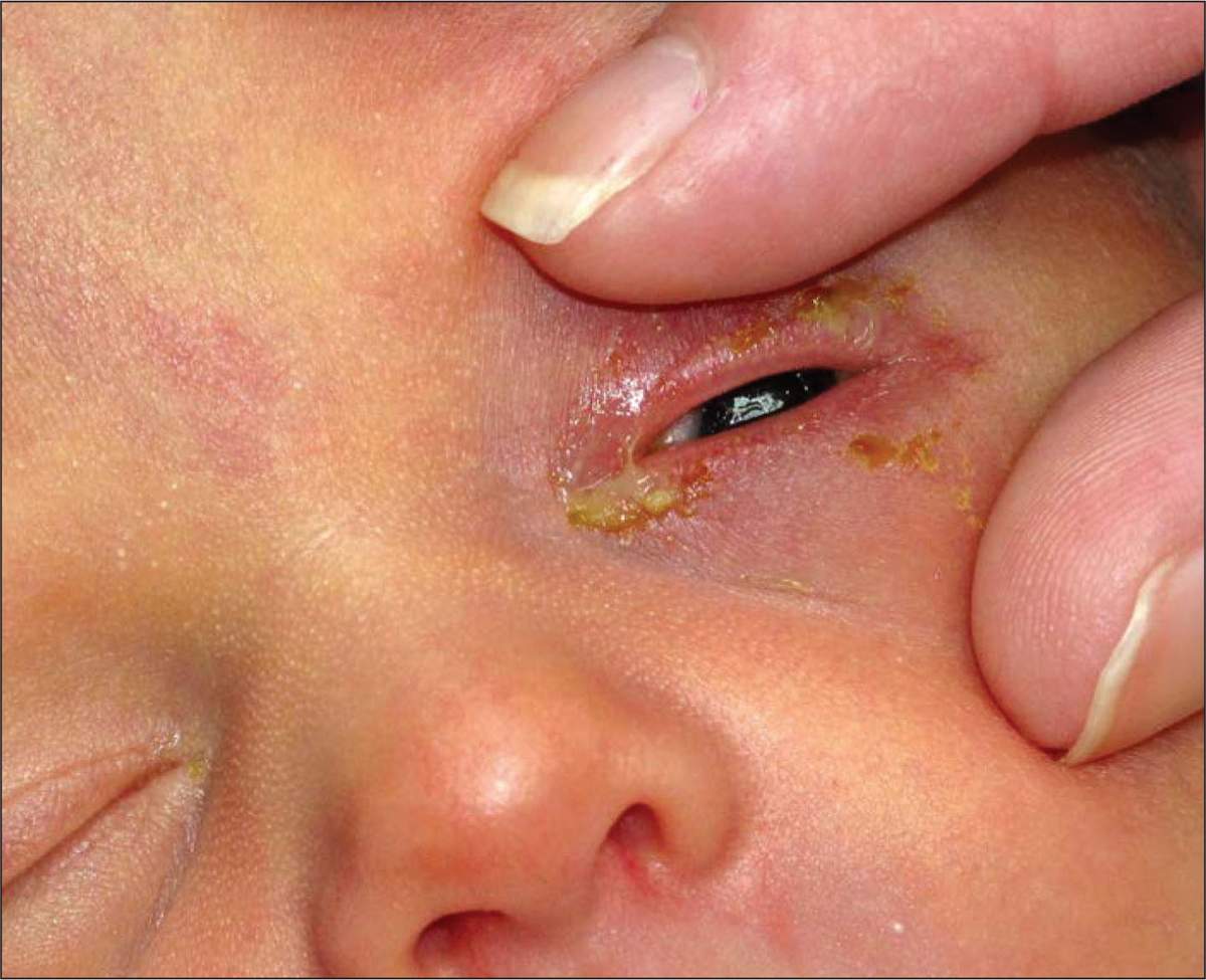 Отек глаза у ребенка 5 месяцев thumbnail