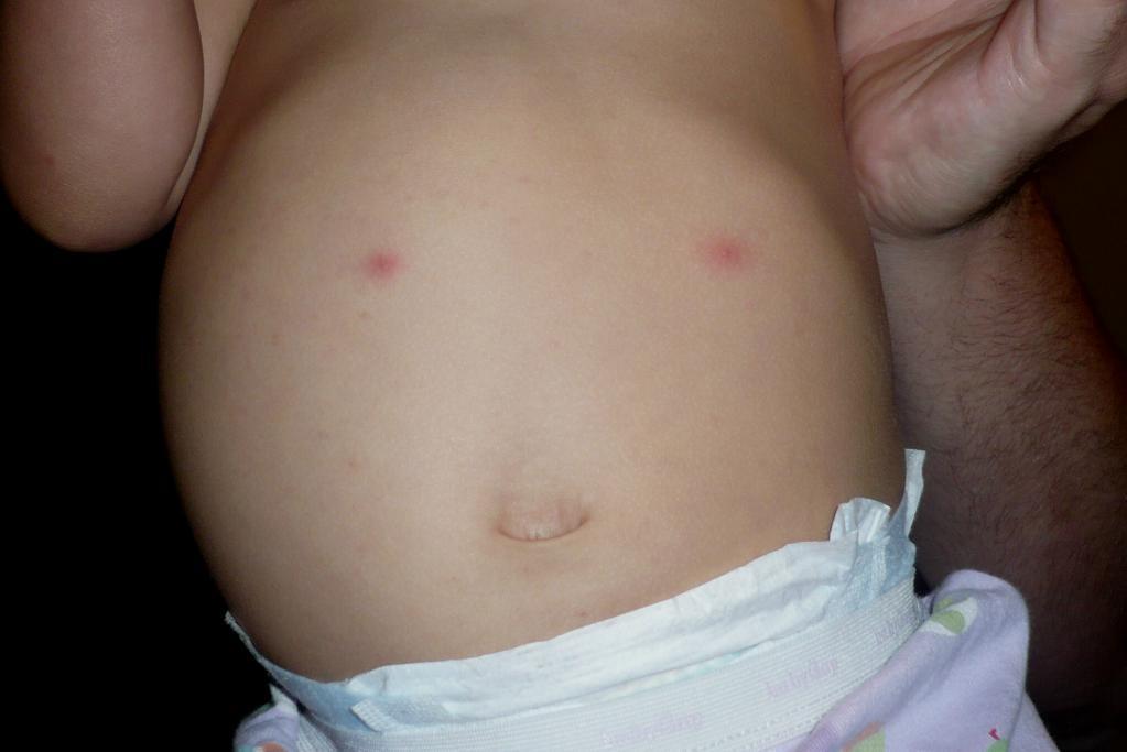 У новорожденного аллергия на животе thumbnail