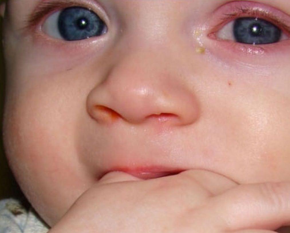 Ребенок 2 года болит глаз thumbnail