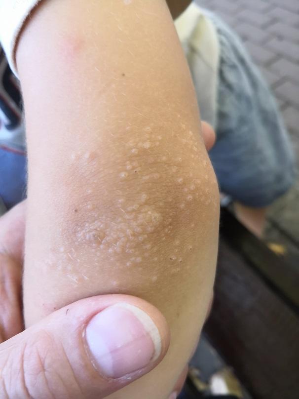 Аллергия как гусиная кожа у ребенка thumbnail