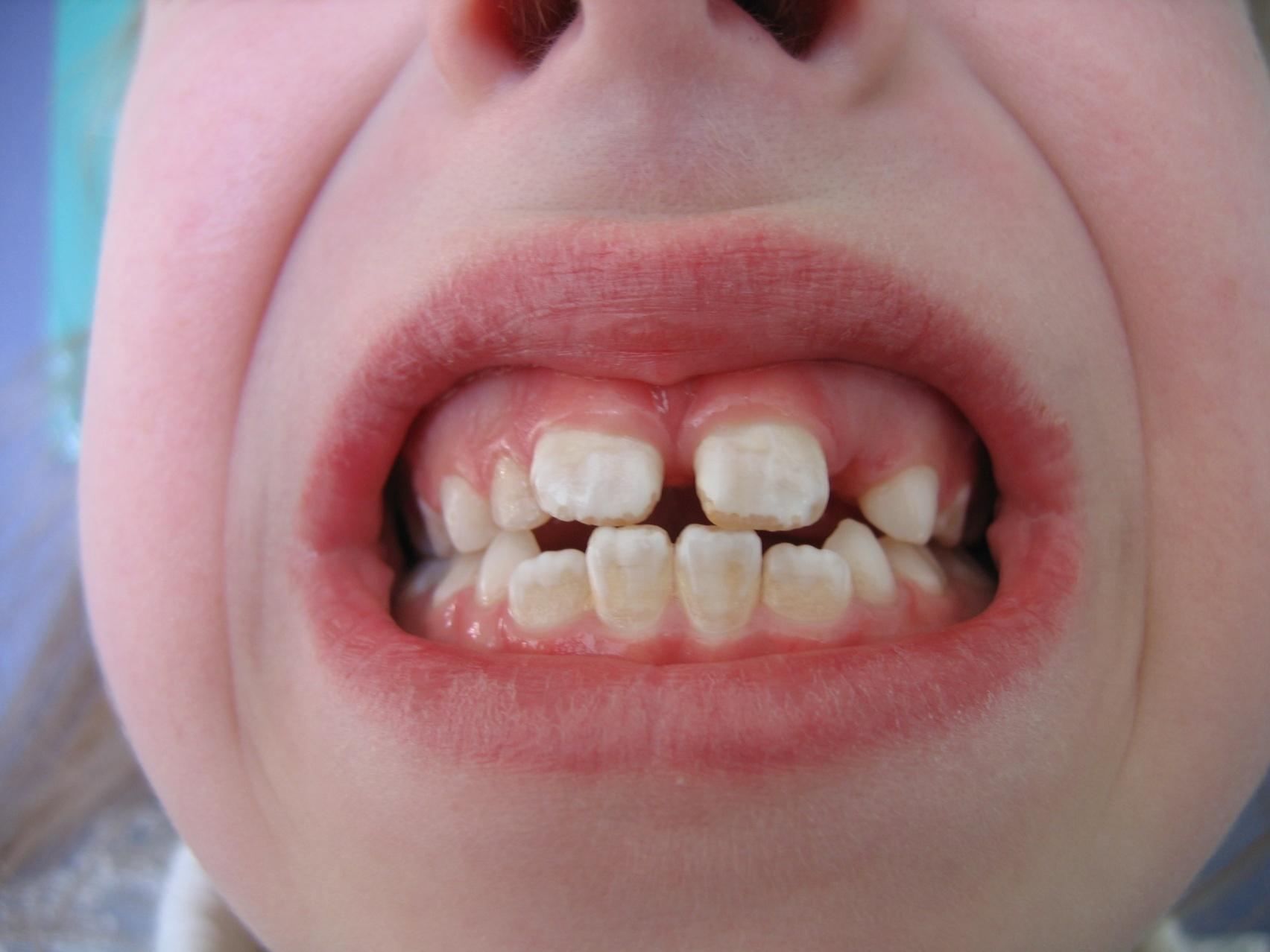 Некариозное поражение зубов – флюороз