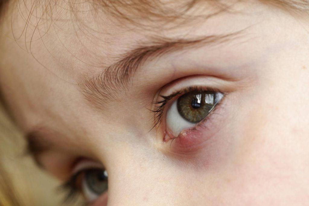 Опухшие глаза и красное вокруг глаз у ребенка thumbnail