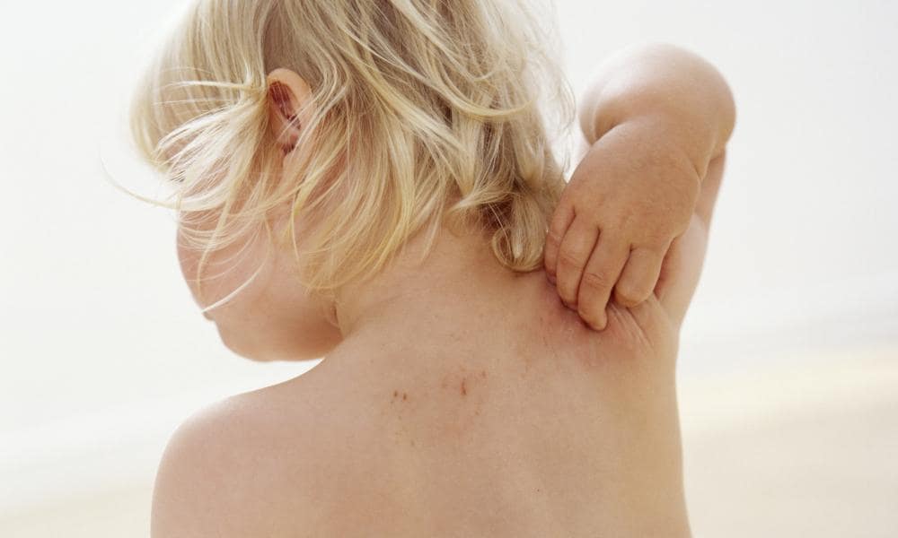 Сыпь в области спины у ребенка thumbnail