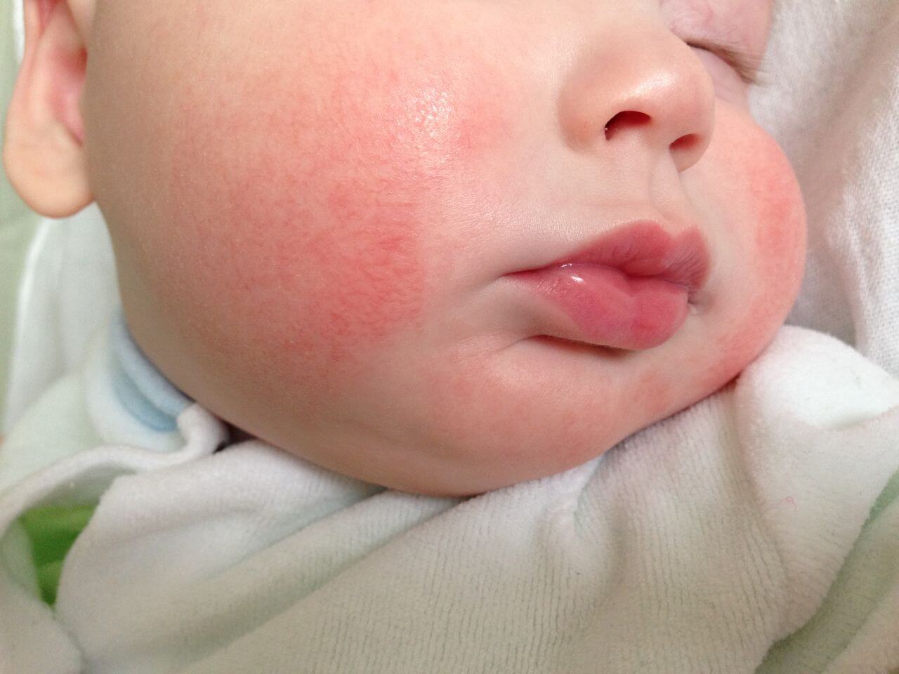 Аллергия сыпь на лице у детей thumbnail