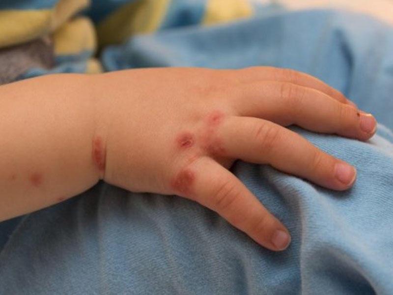 Сыпь у ребенка на руке