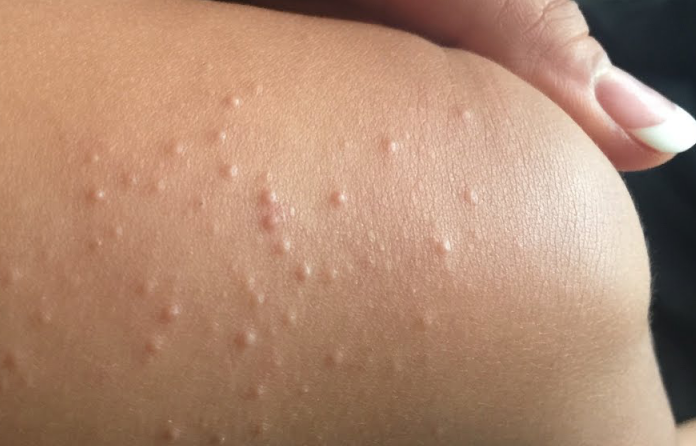 Аллергия на локтях и коленях у грудничка thumbnail
